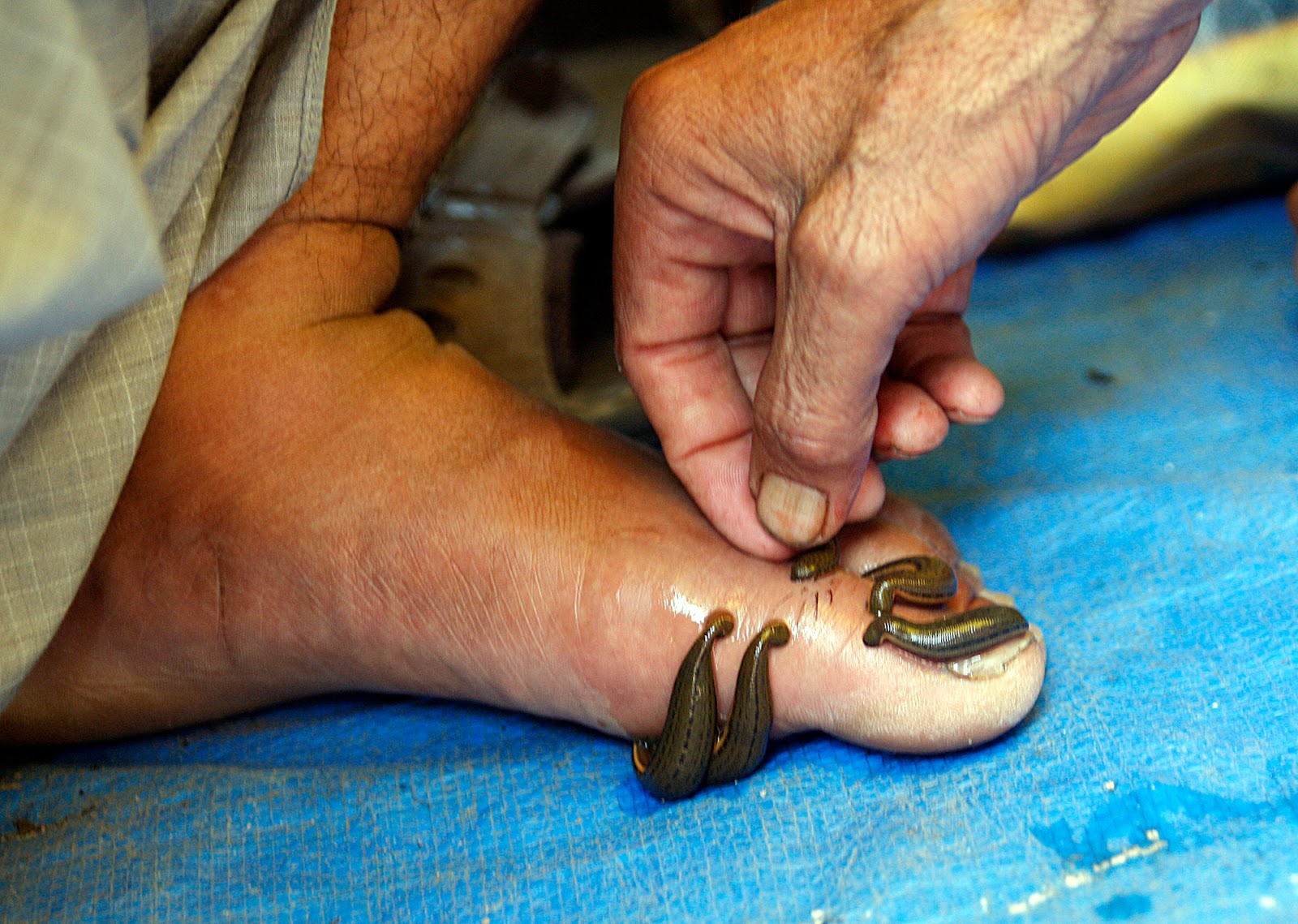 ಲೀಚ್ ಥೆರಪಿ